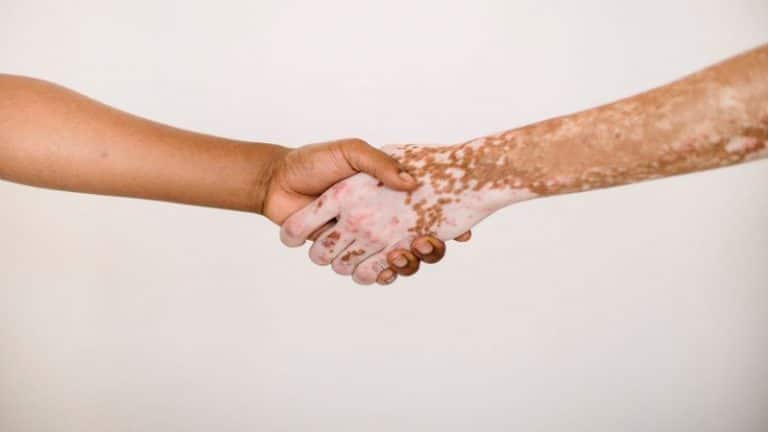 PSORIASIS