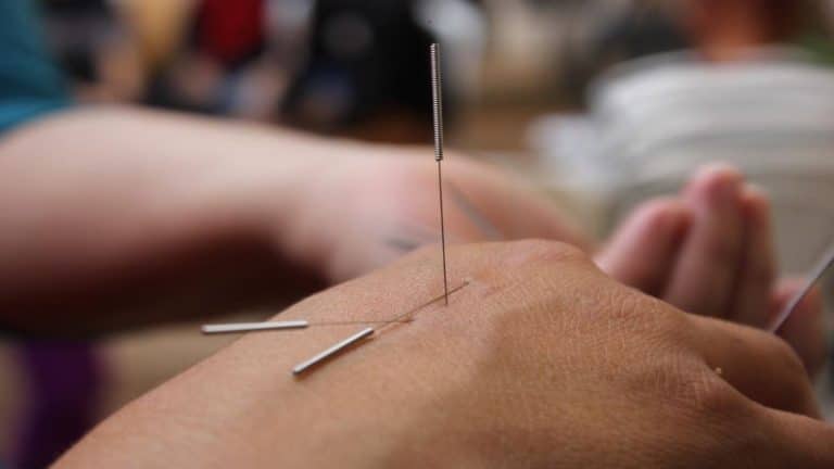 acupunctureee